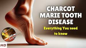 CMT Hastalığı Charcot-Marie-Tooth Hastalığı