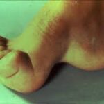 CMT Hastalığı Charcot-Marie-Tooth Hastalığı