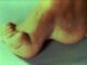 CMT Hastalığı Charcot-Marie-Tooth Hastalığı