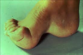 CMT Hastalığı Charcot-Marie-Tooth Hastalığı